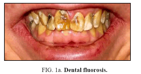 international-journal-chemical-sciences-Dental-fluorosis